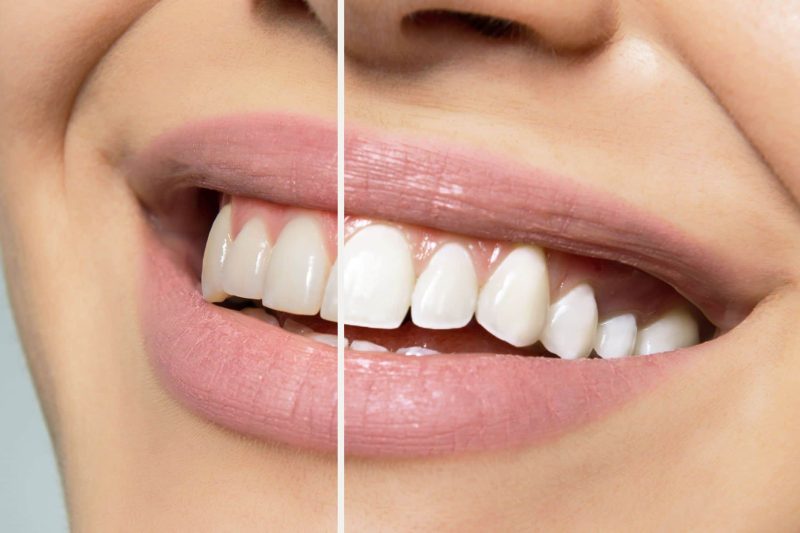 blanchiment-dr-morgane-cohen-chirurgien-dentiste